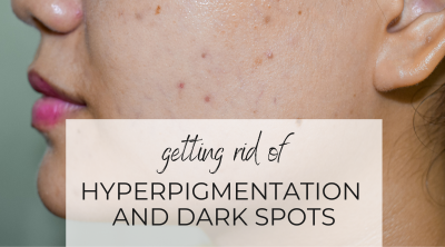 Getting Rid of Hyperpigmentation and Dark Spots