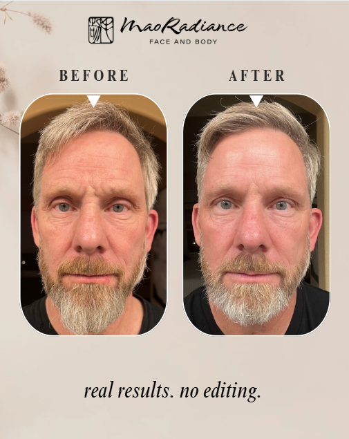 Before and after comparison of a man's face with Mao Radiance branding.