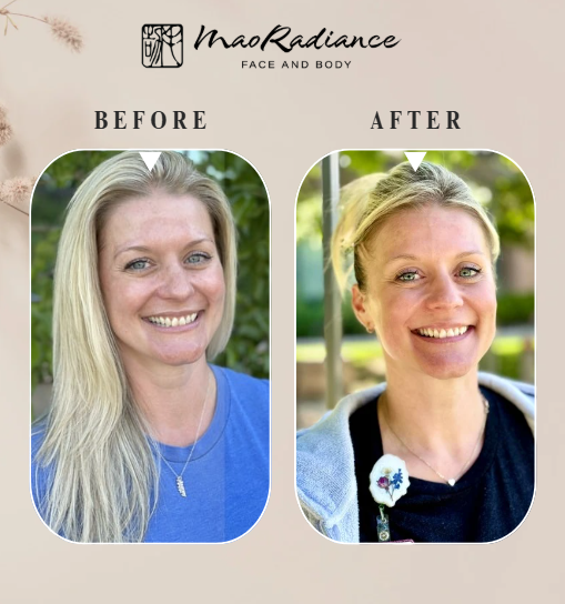 Before and after comparison of a woman's face with Mao Radiance branding.