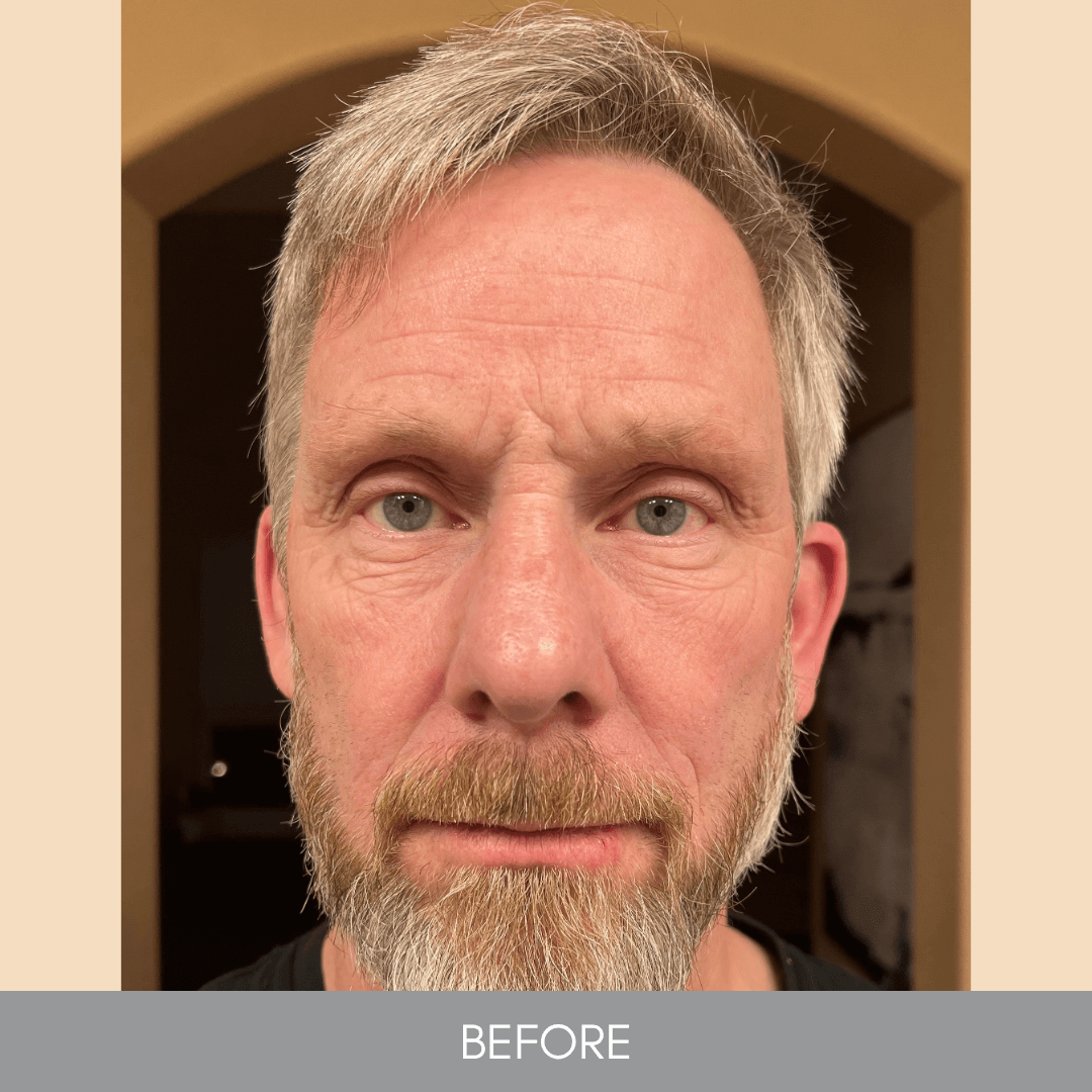 Close-up of a man with gray hair and beard, labeled 'Before' on a beige background.