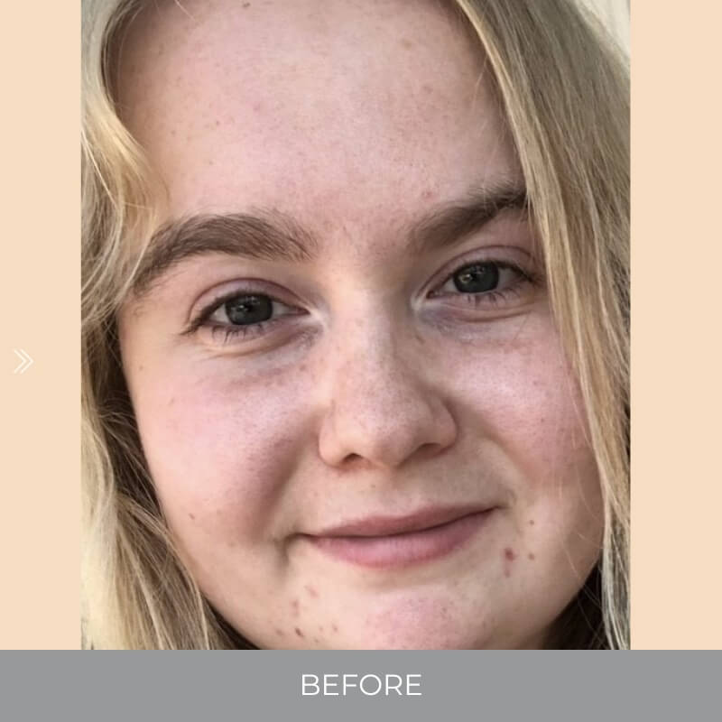 Close-up of a person with blonde hair and freckles, labeled 'Before' on a beige background.